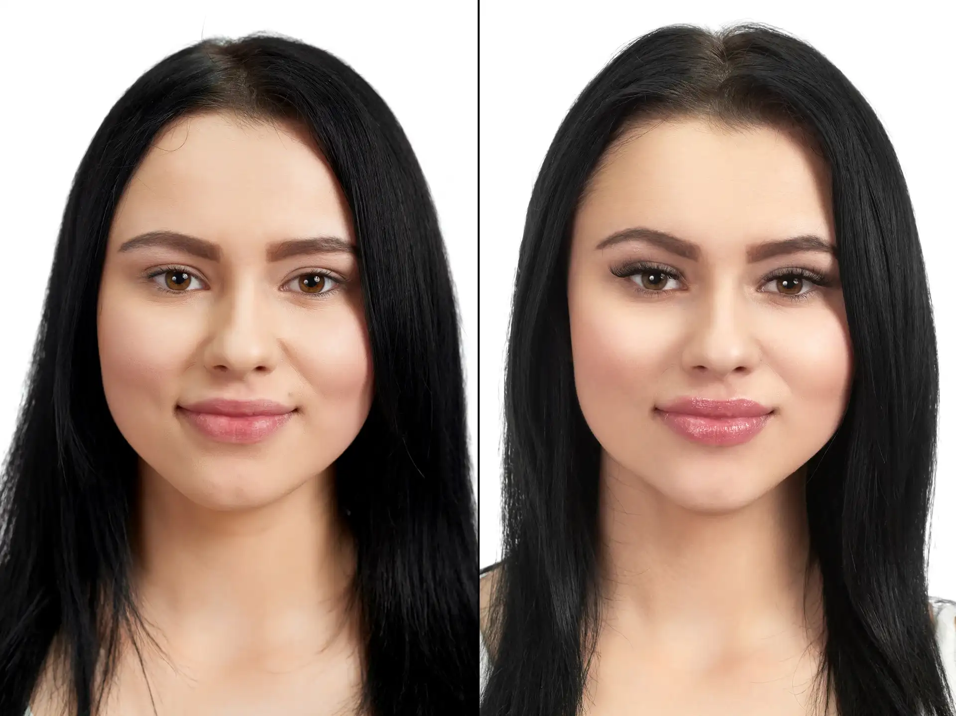 Restylane before-and-after