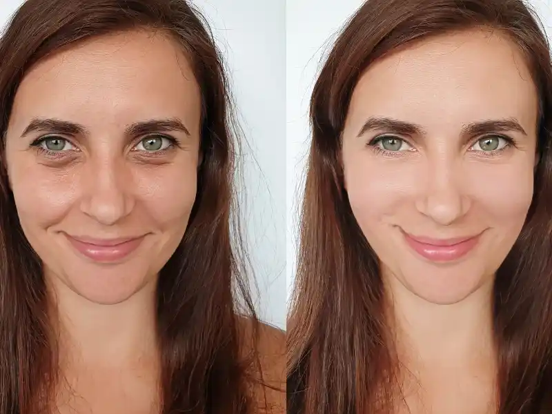 hydrafacial before after