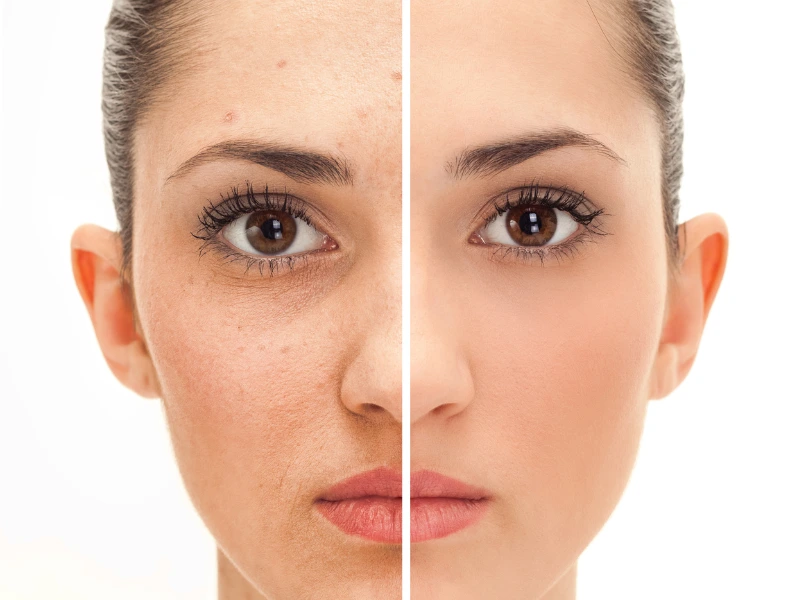 juvederm before and after
