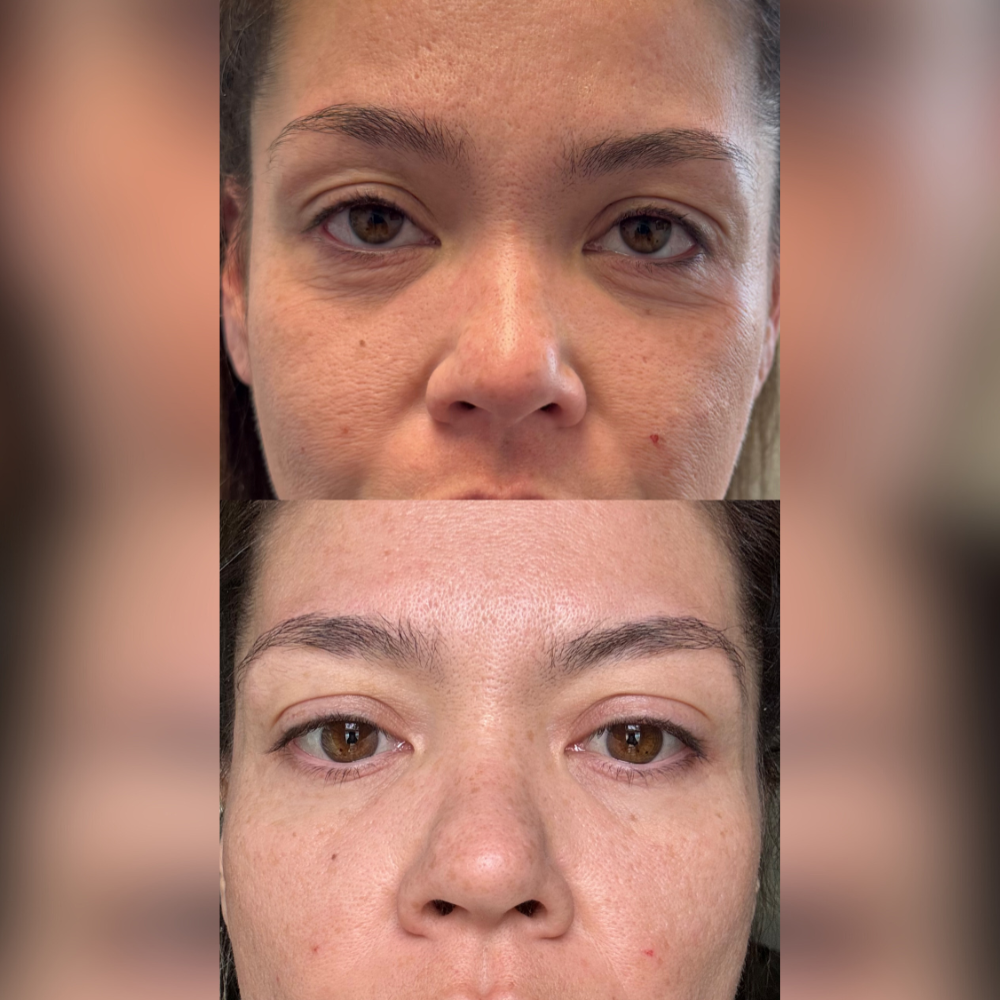before after exosomes face