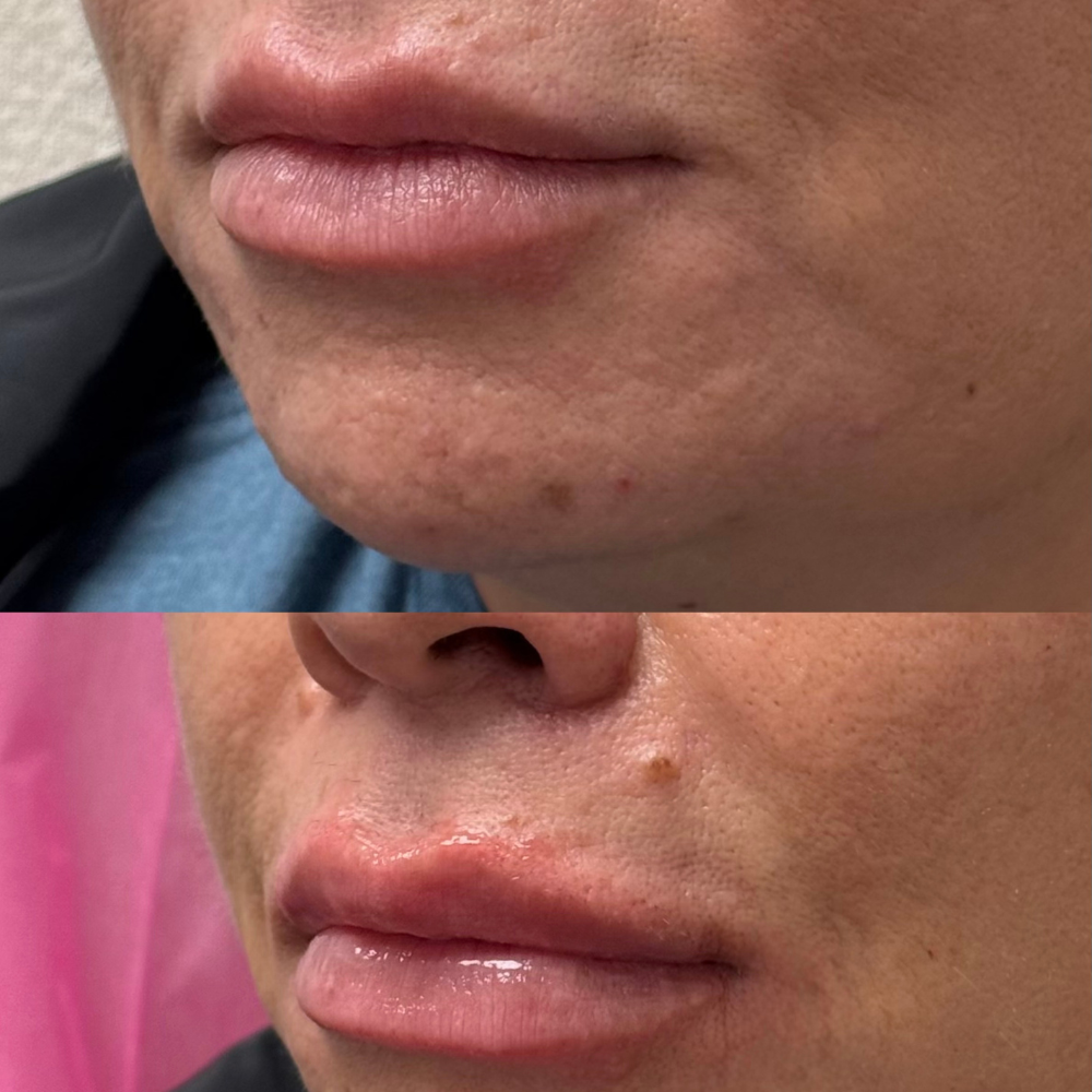 before after lip fillers