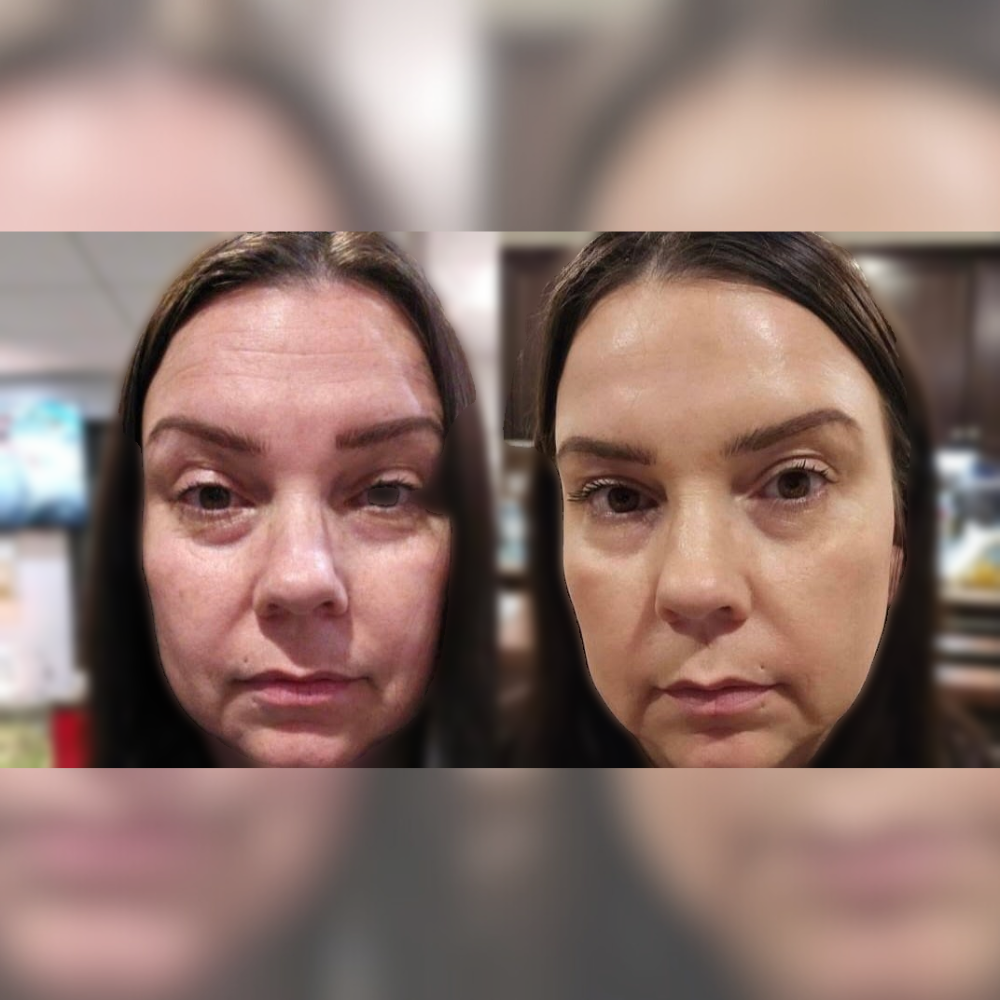 before and after botox​