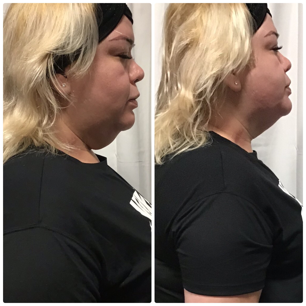 cryo t shock arms treatment before after