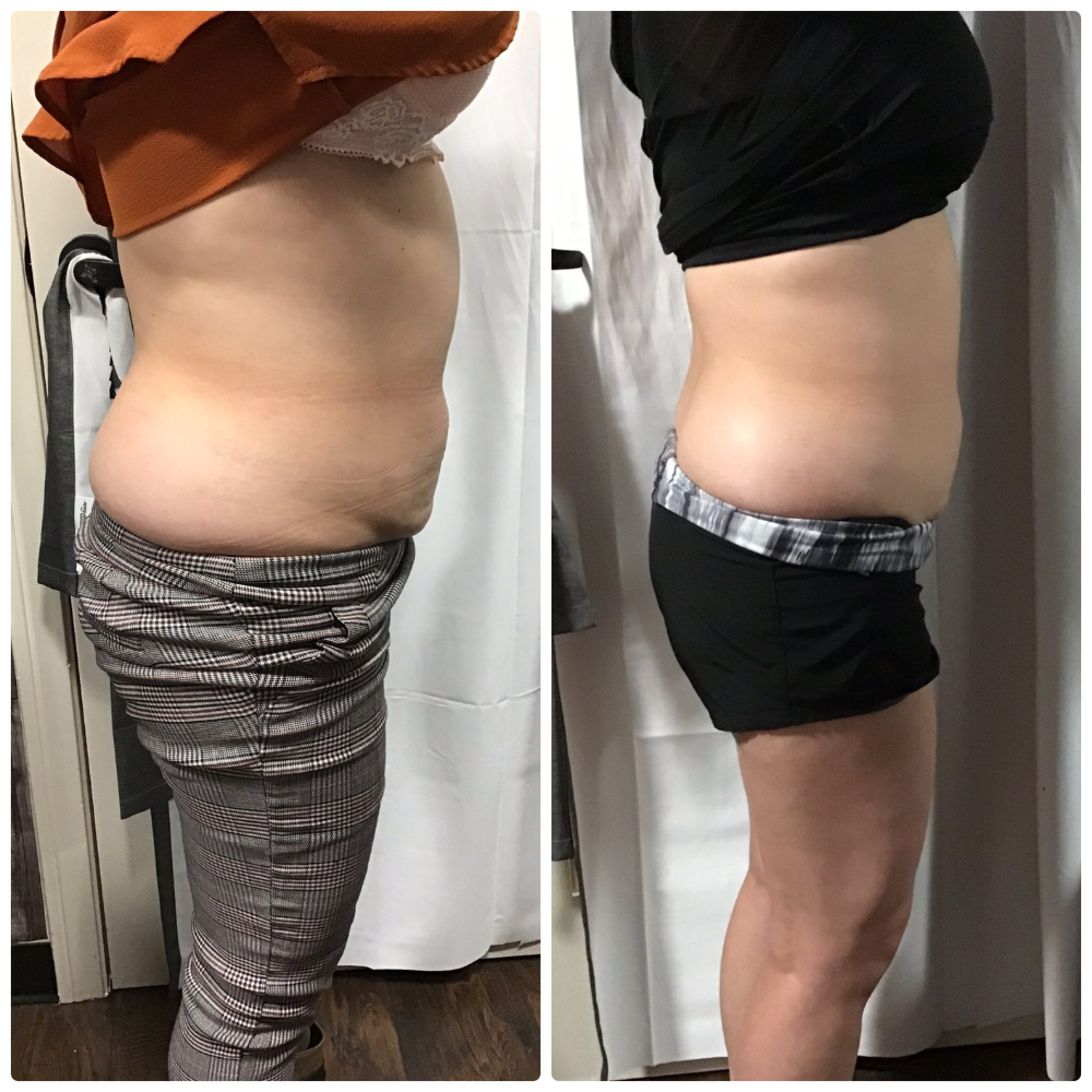 cryo t shock double chin treatment before after