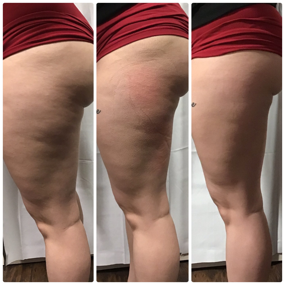 cryo t shock legs treatment before after