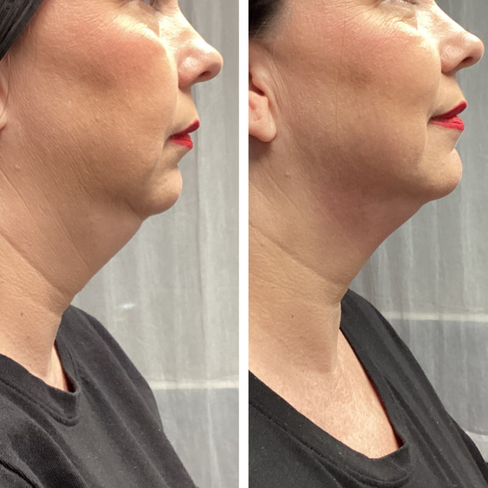 cryo t shock love handles treatment before after