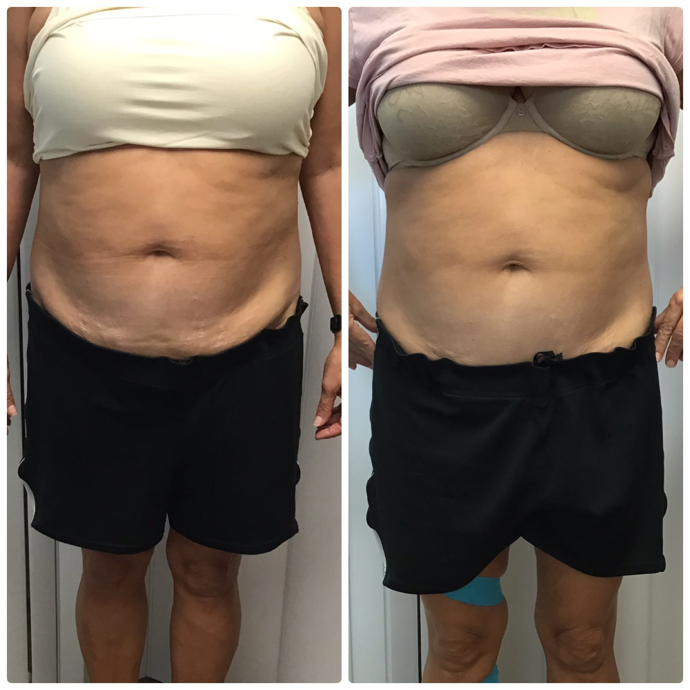 cryo t shock stomach treatment before after