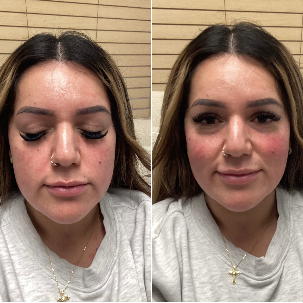 dermal filler before after