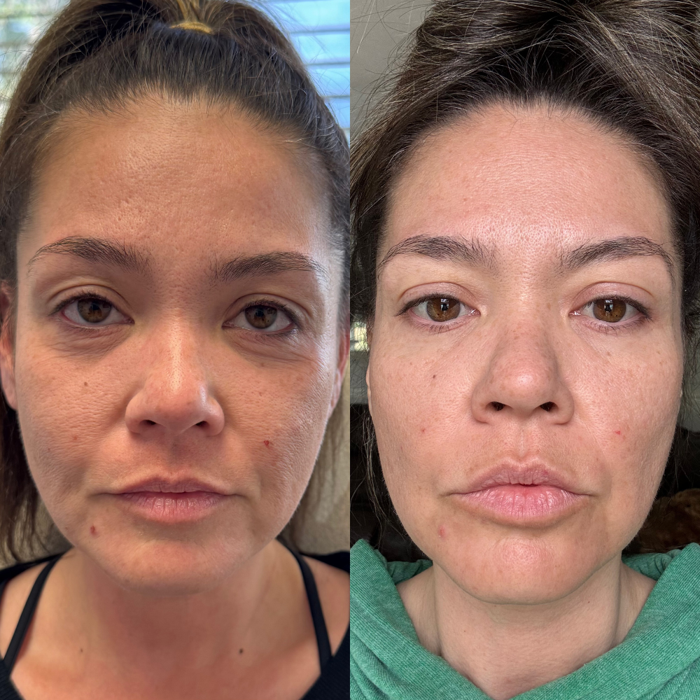 exosomes face before and after