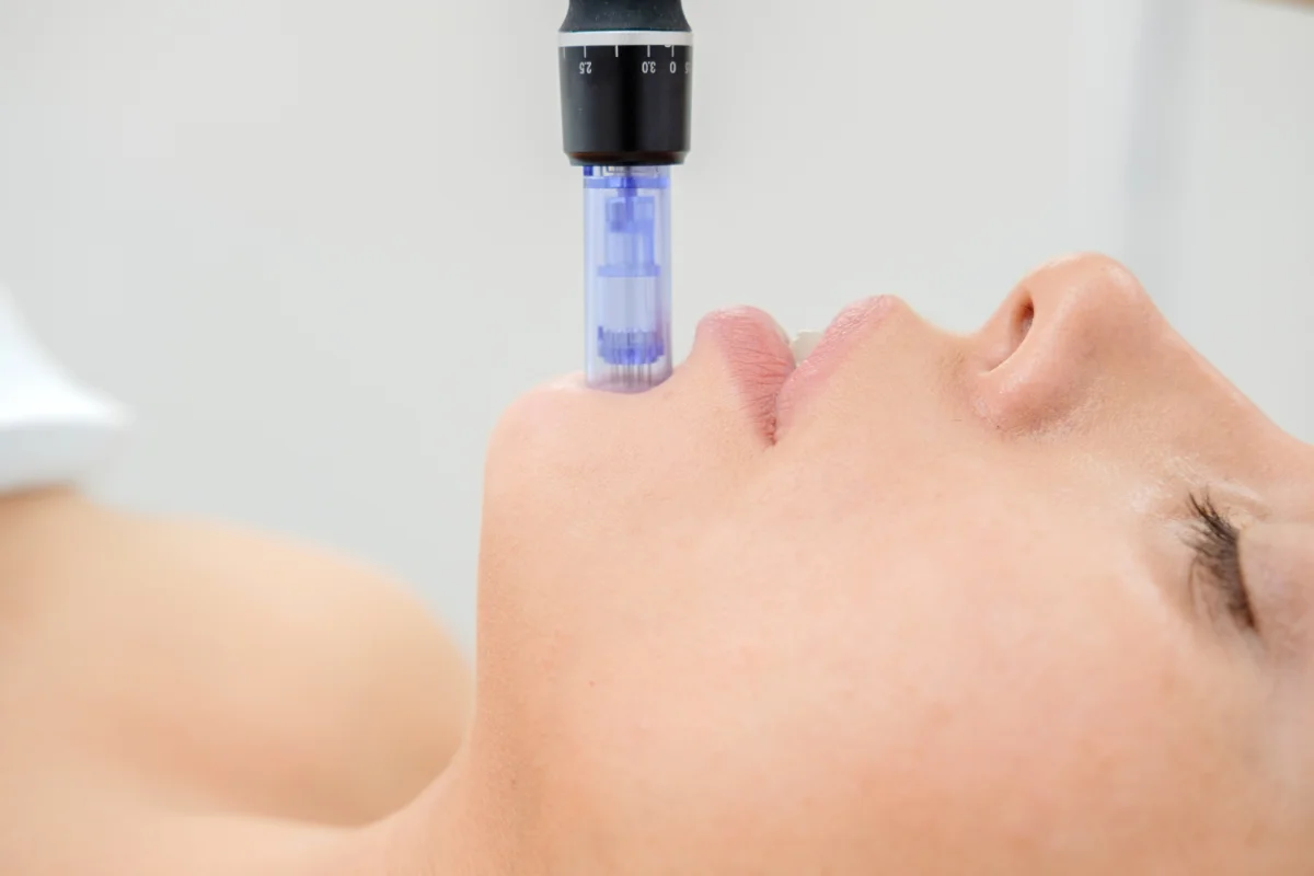 ideal candidates for rf microneedling treatments