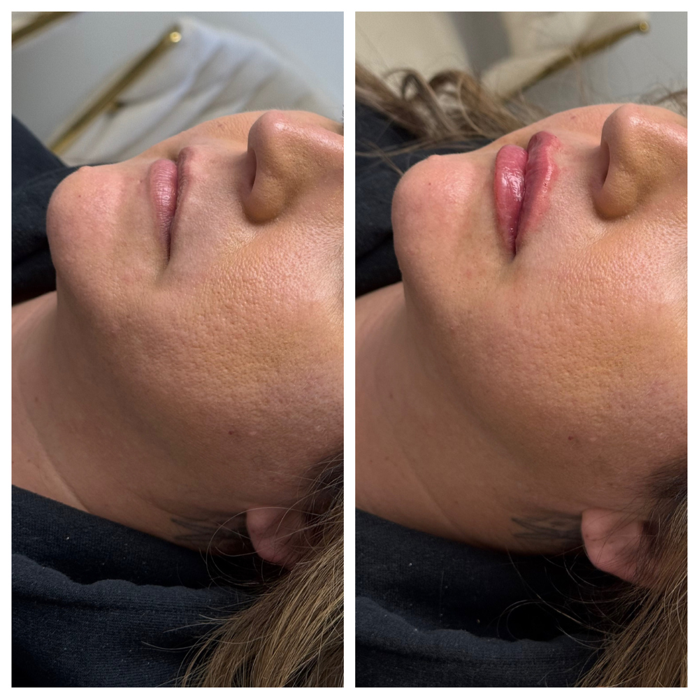 lip fillers before after