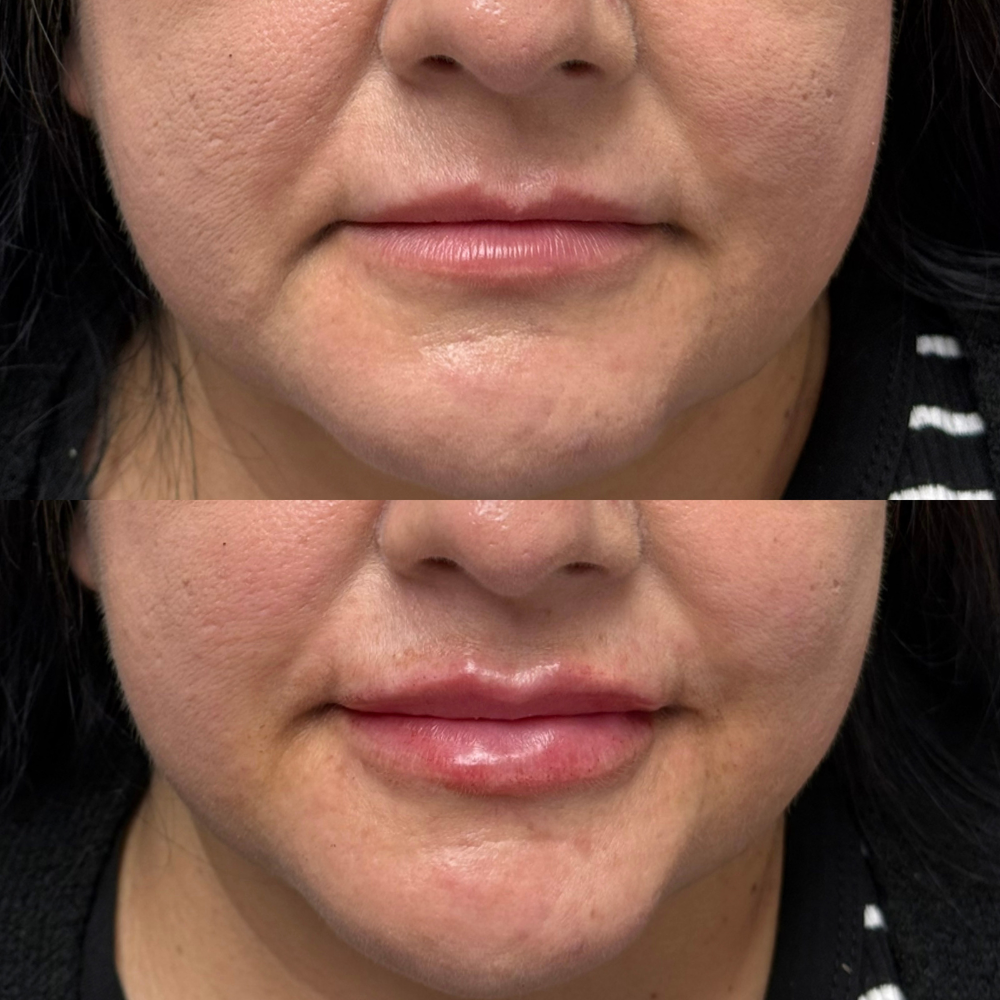 lip fillers before and after