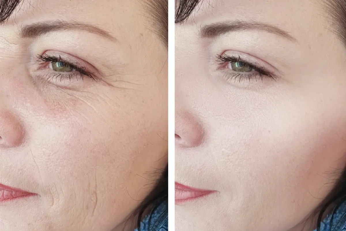 microneedling before and after